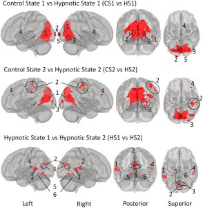Brain imaging comparison showing activated regions during control states versus hypnotic states, displayed from left, right, posterior and superior views