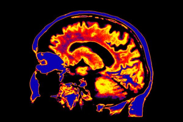 Sagittal brain scan showing neural activity during hypnosis, with active regions highlighted in yellow and orange against a blue background