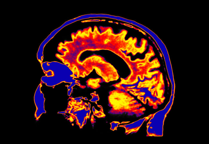 What happens in the brain during hypnosis?
